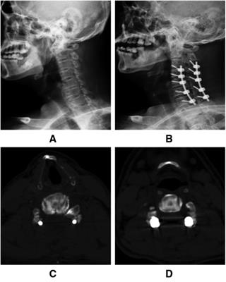 Evaluation of enlarged laminectomy with lateral mass screw fixation in relieving nerve root symptoms and correcting kyphosis for cervical myelopathy and radiculopathy